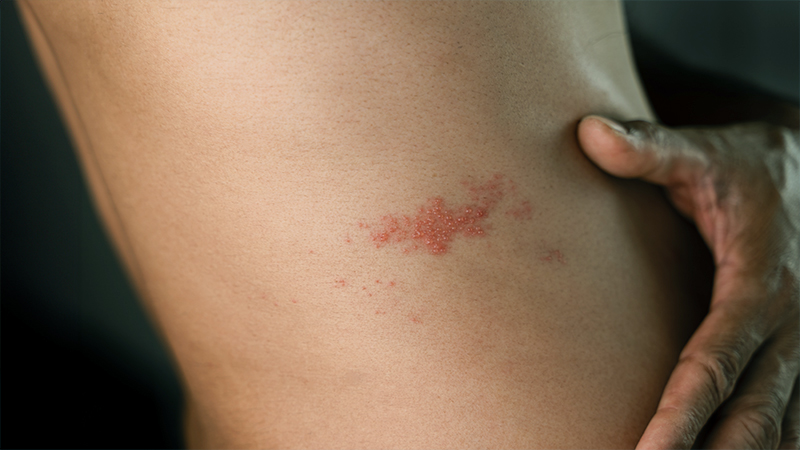 Creatine Cause Rashes