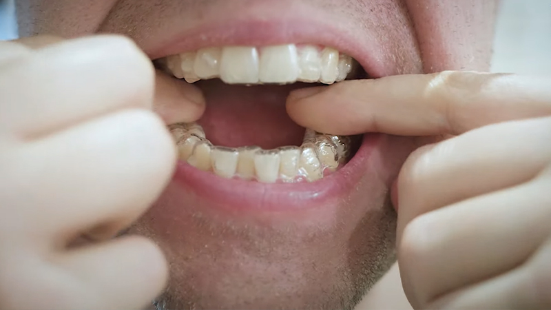 Drinks and Foods to Avoid While Wearing Invisalign