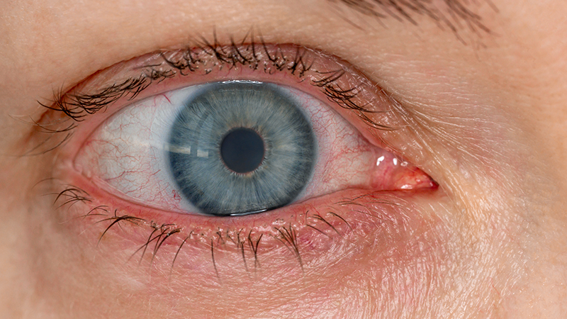 Factors Contributing to Eye Redness