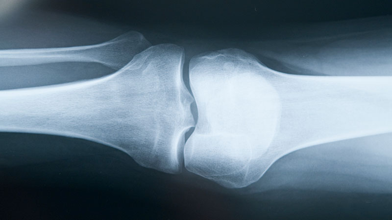 Enhanced Bone Health and Density
