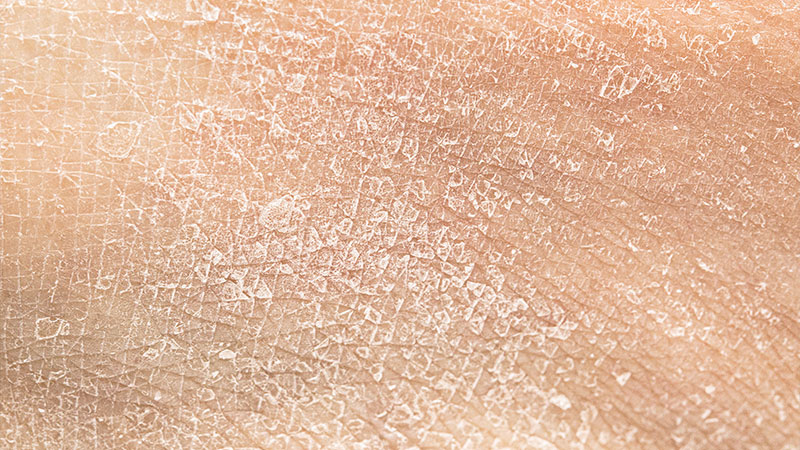 Dry Skin