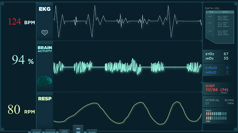 Electrocardiogram