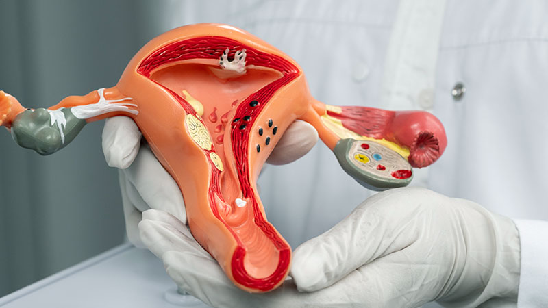 Polycystic Ovary Syndrome