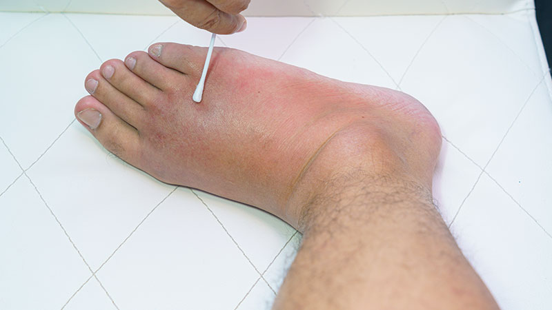 Swelling