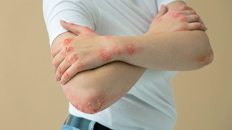 Rash Triggers and Patterns