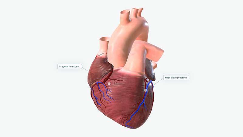 Underlying Cardiovascular Conditions
