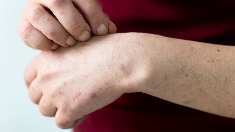 When to See A Doctor for Anxiety Skin Rash
