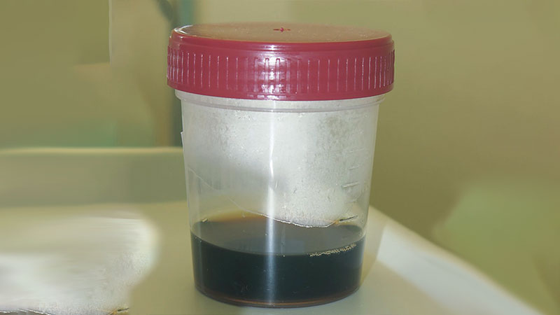 Dark Urine