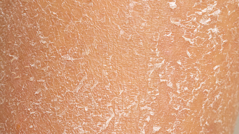 Dry Skin