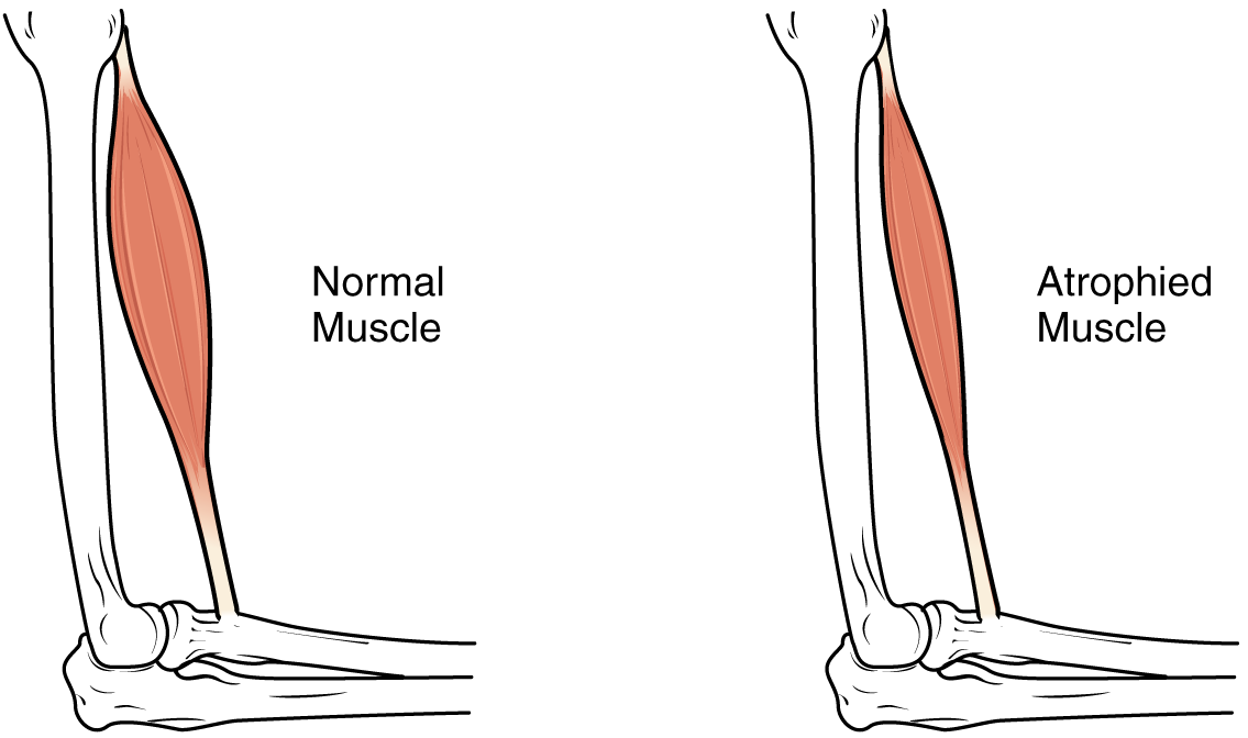 Sarcopenia