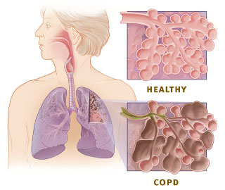 COPD