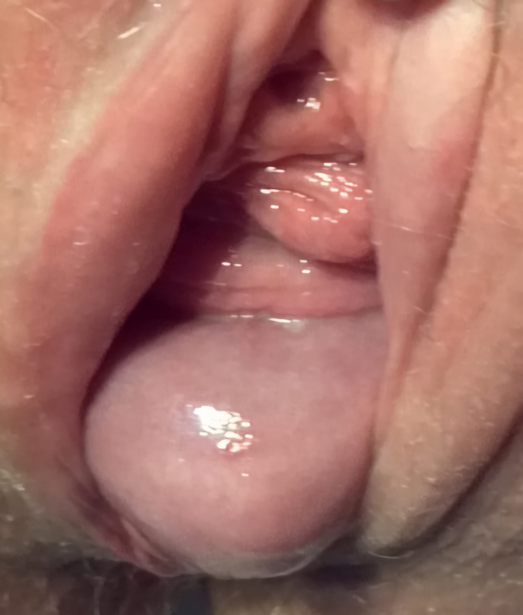 Pelvic Organ Prolapse